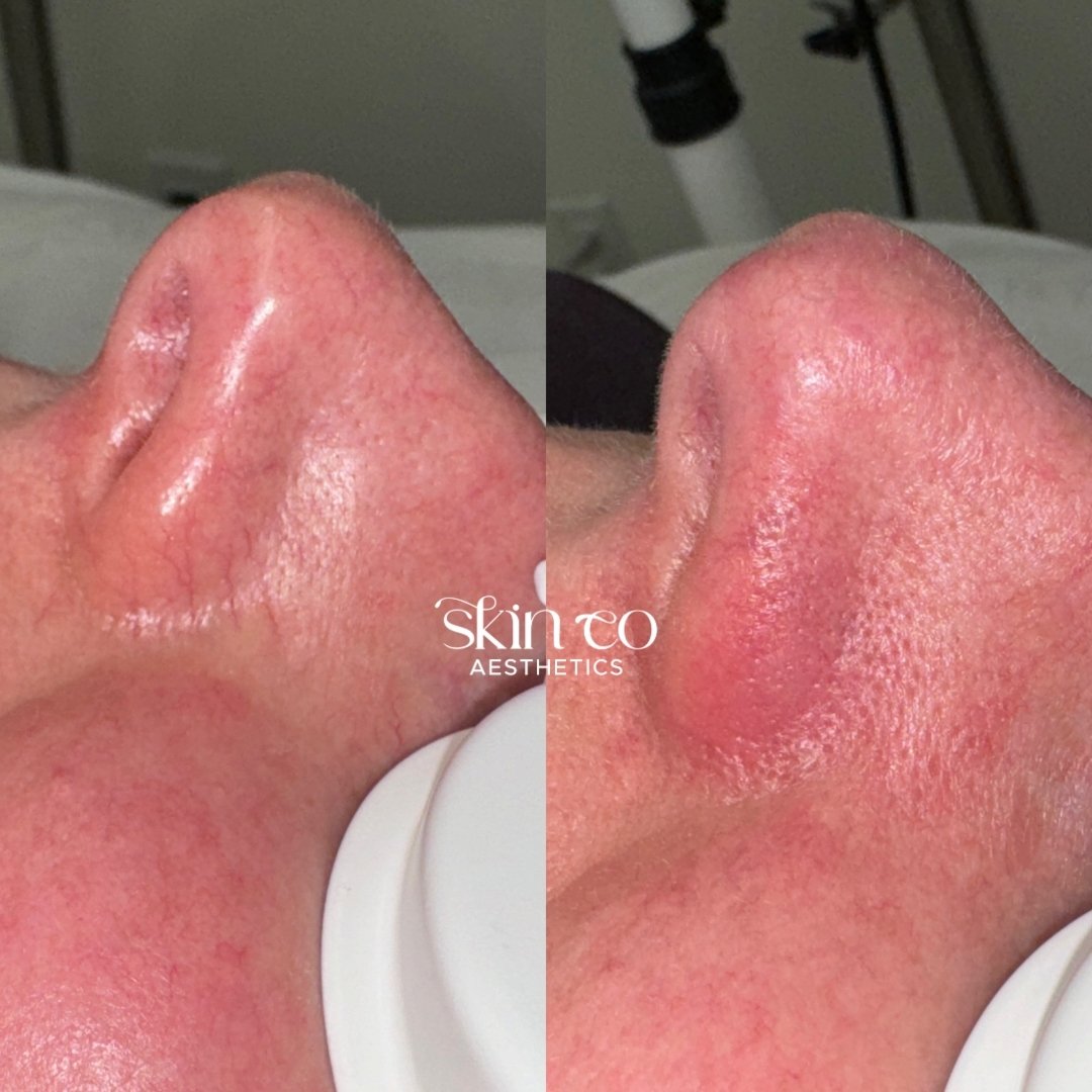 and just like that.. spider veins gone in minutes 💥

Telangiectasias aka spider veins are small, widened blood vessels near the surface of the skin. Although harmless, they can be annoying! 

We target these spider veins with the Aerolase Neo &amp; 