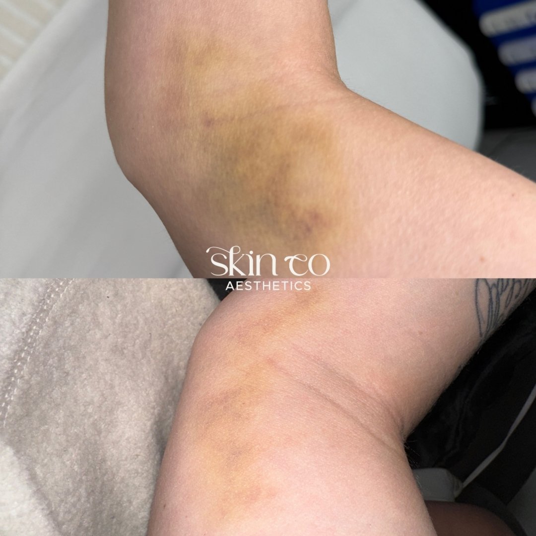 AEROLASE FOR BRUISING 💥

Yup.. we can treat bruises of all kinds! so if you bruise like a peach this treatment is for you 🍑

These 2 photos are after only 1 treatment, 1 day later! 

How does it work? because bruising is caused by broken blood vess