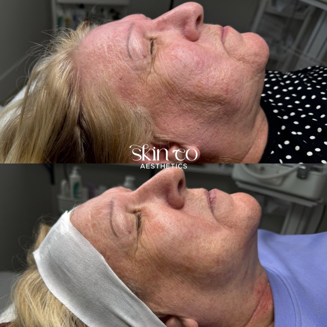 STOP SCROLLING!!! 👀🔥

I am SCREAMING over these results after only ONE SESSION of Aerolase Skin Rejuvenation plus 2 weeks on a Professional grade regime curated by moi 🤭

If you&rsquo;re looking for results like these - I&rsquo;m your gal &amp; I&