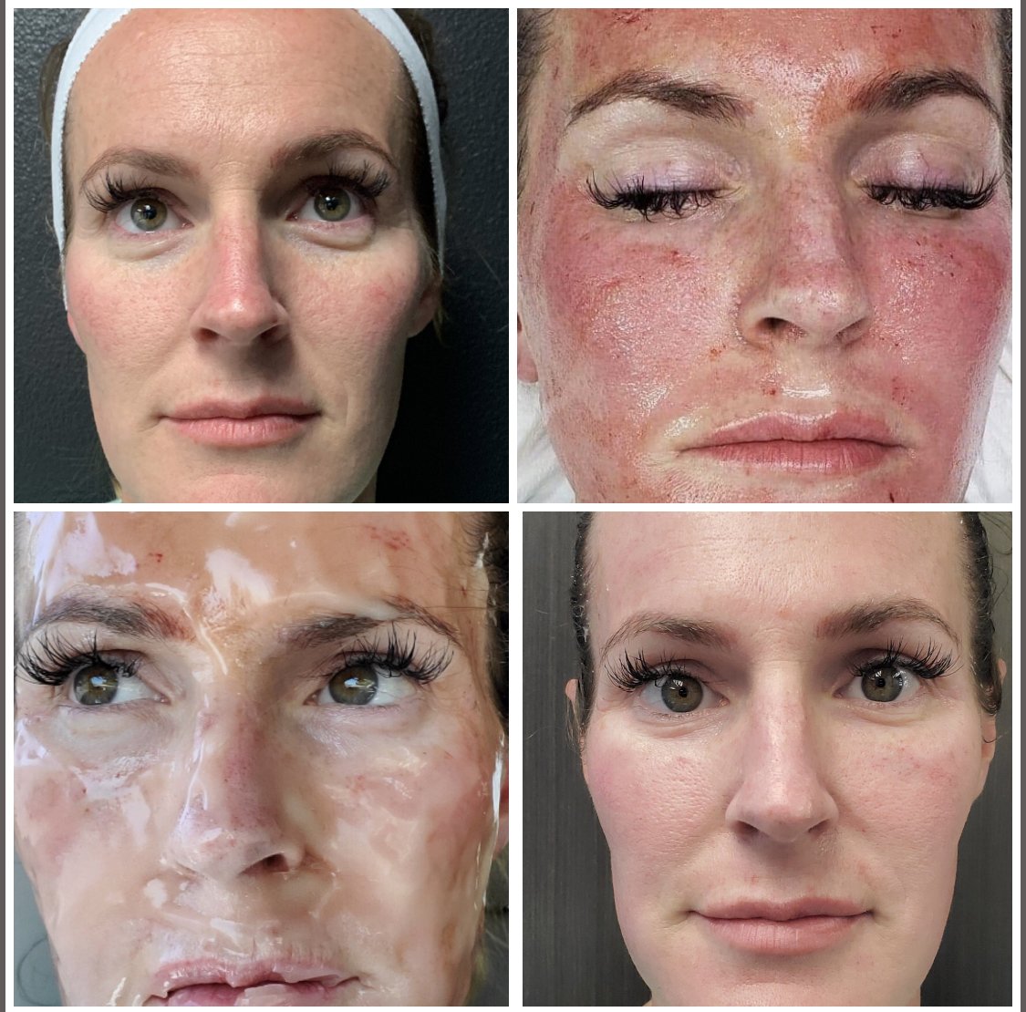 CO2LiftPRO_Directly after Microneedling-1.jpg