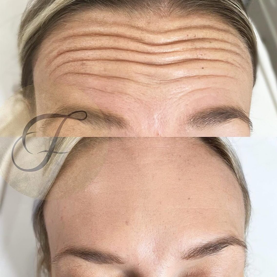 Feminising the brow and forehead with a sprinkle of anti wrinkle 💗 @finessed_bynursemolly