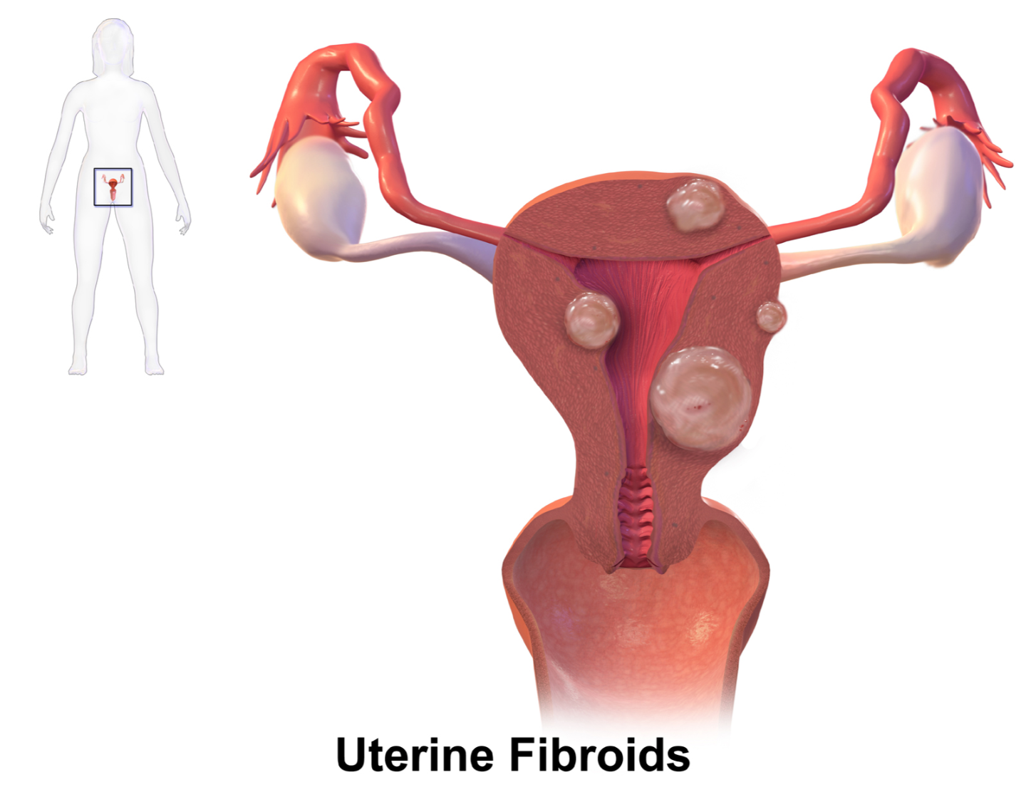 Uterine Fibroids & Dysfunctional Uterine Bleeding