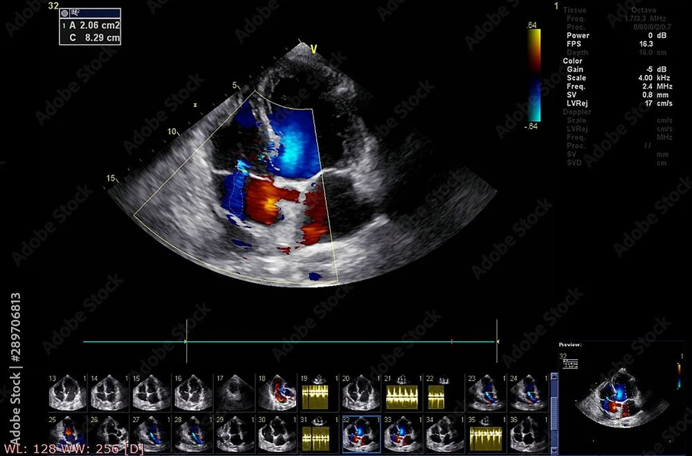 Echocardiogram