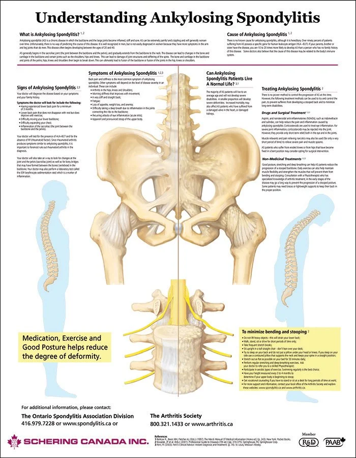 Ankylosing_Spondylitis.jpg