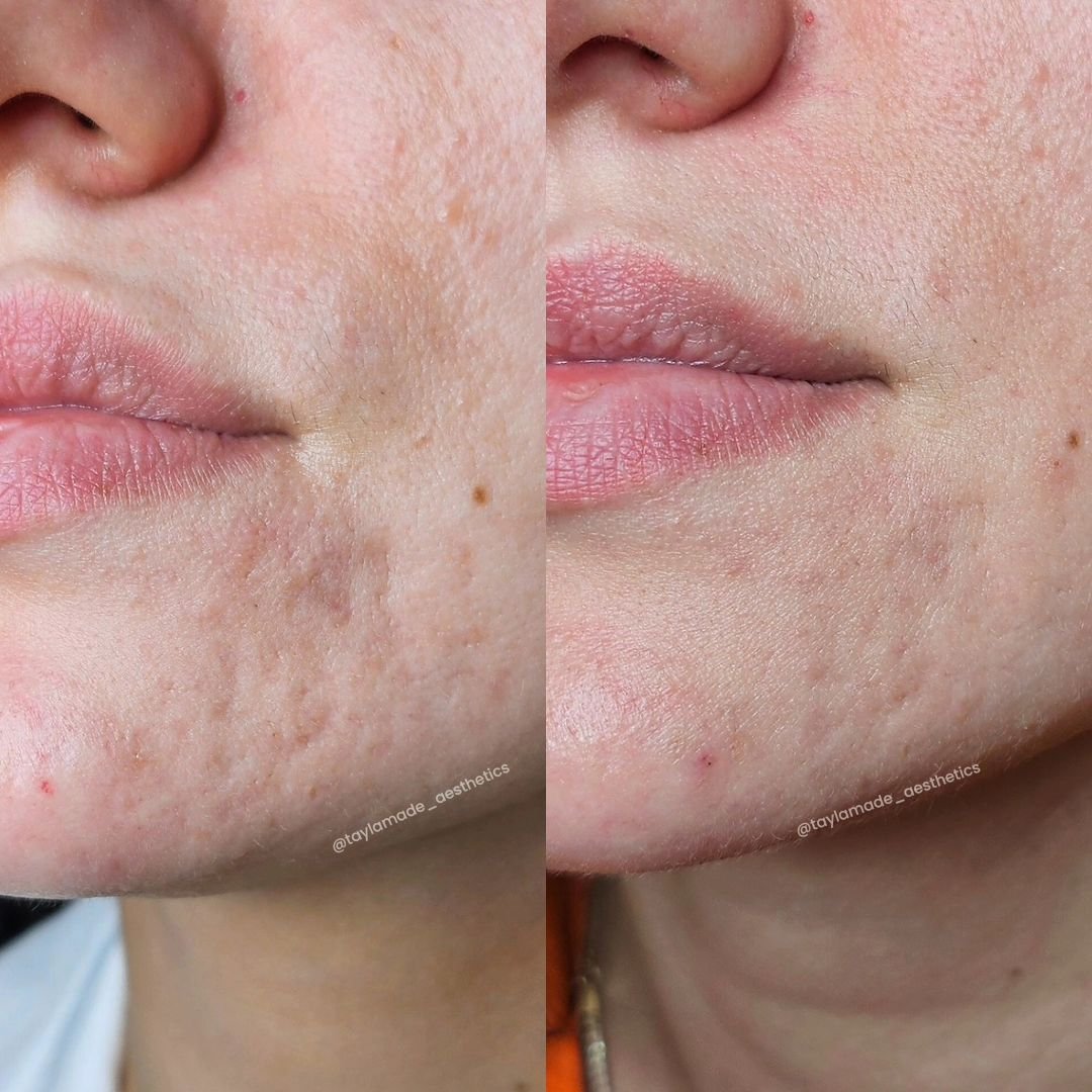 🪄Is there anything NCTF can't do!?✨️

⏳️2 weeks post first treatment! 

👩🏽&zwj;⚕️Let me share with you my approach to treating acne scars as a Dermatology &amp; Aesthetic Nurse

ℹ️Acne can leave the skin with different types of scars and it's impo