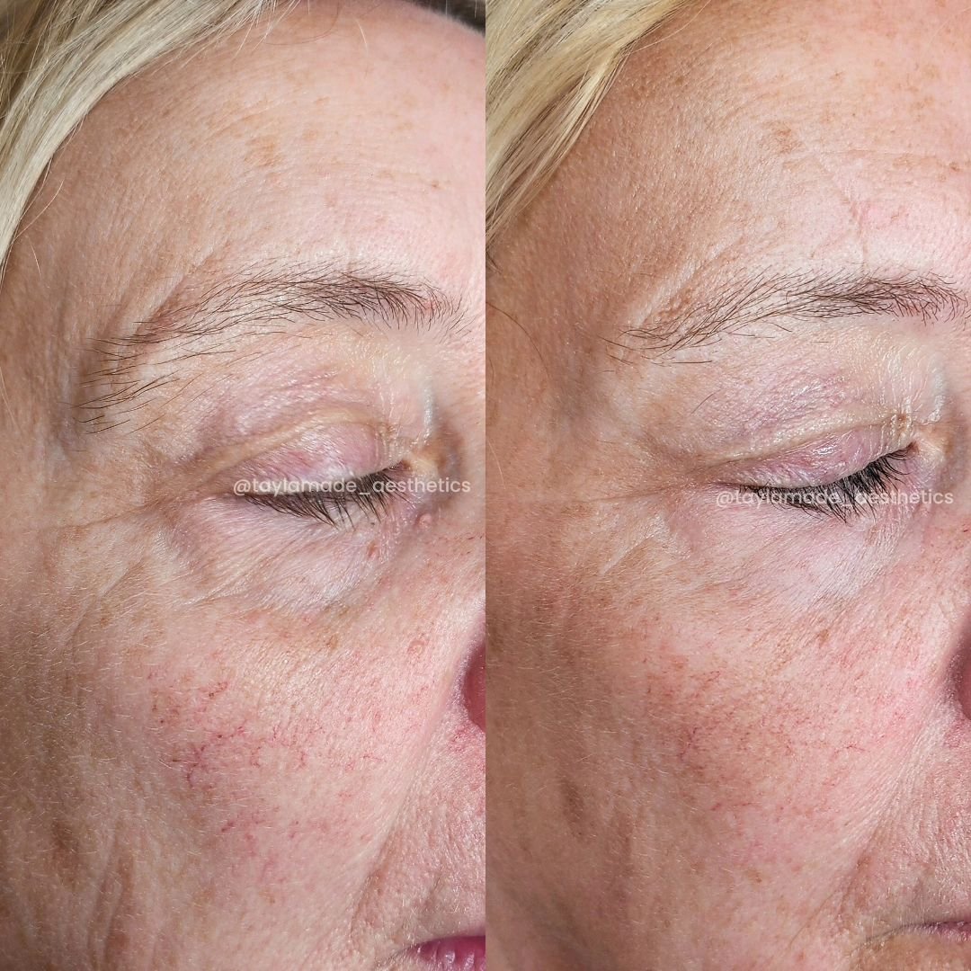 ⏰️5 Weeks Post 1 NCTF Treatment

✅️Reduction in Fine Lines/Wrinkles
✅️Reduction in Puffiness
✅️Increased Skin Laxity
✅️Smoother Skin Surface
✅️Tighter &amp; Firmer Skin

🫣but definitely not a tanned client of a Dermatology Nurse...

#NCTF #nctf135 #