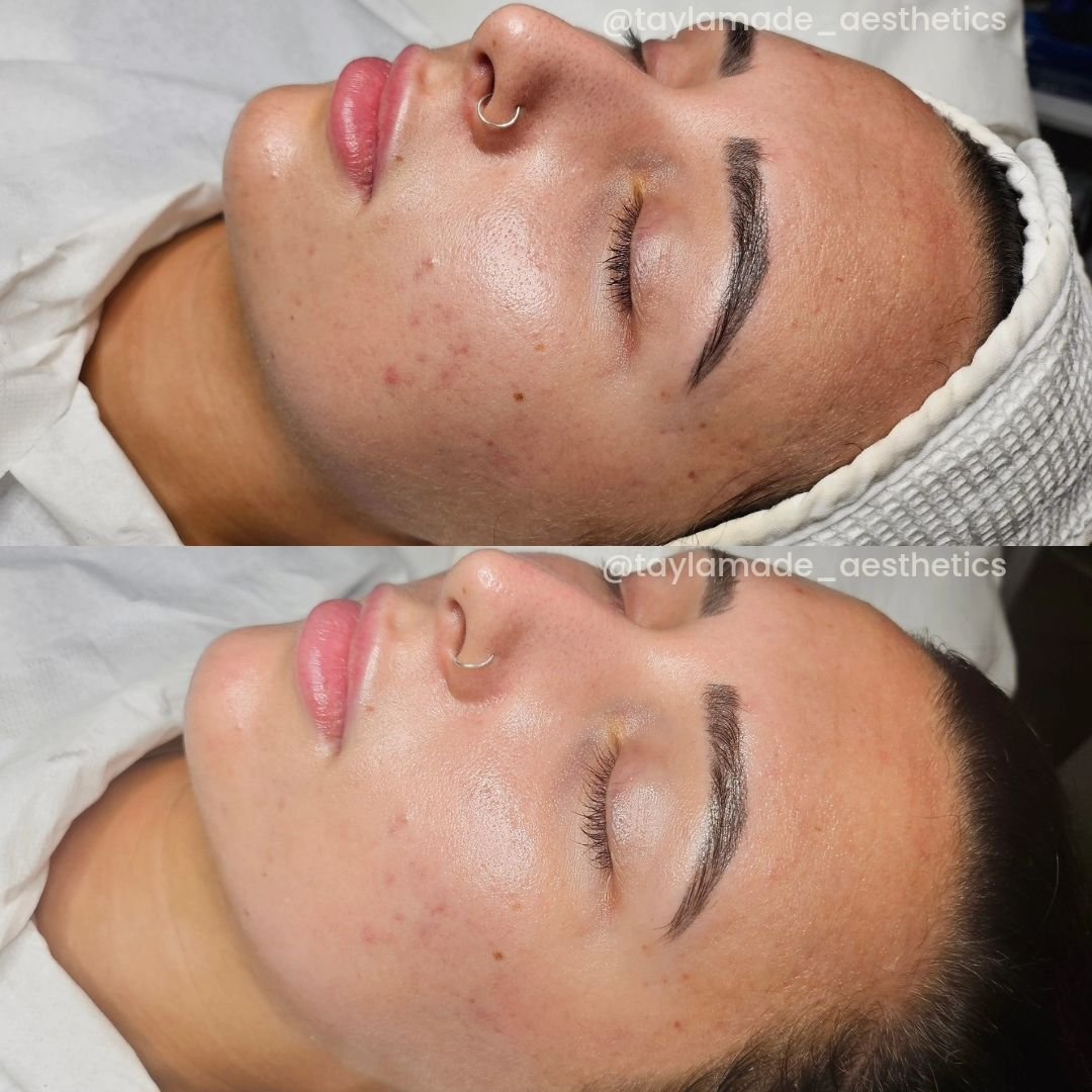 A lot can happen when you dedicate 60 minutes to yourself✨️

🧼Derm Facial 60💖

A treatment tailored to meet your skin needs performed by a Dermatology &amp; Aesthetic Nurse👩🏽&zwj;⚕️

Although my beautiful client's main focus was to reduce the bla