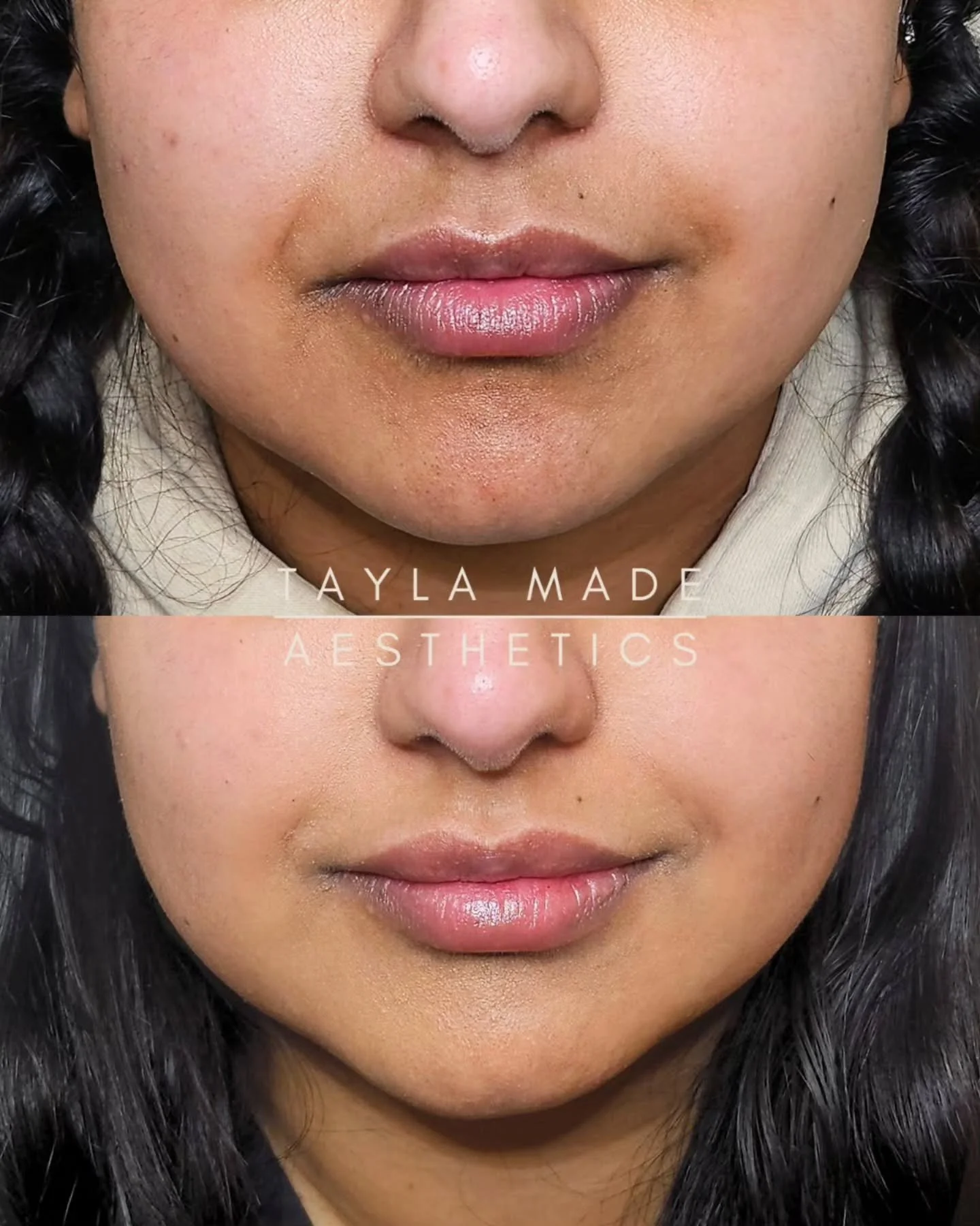 Want a more even skin tone?👇🏽

NCTF truly works wonders when it comes to skin rejuvenation with it's unique formula of 60 ingredients💫

My lovely client wanted to achieve a brighter skin tone, as she always felt her skin was darker around her mout