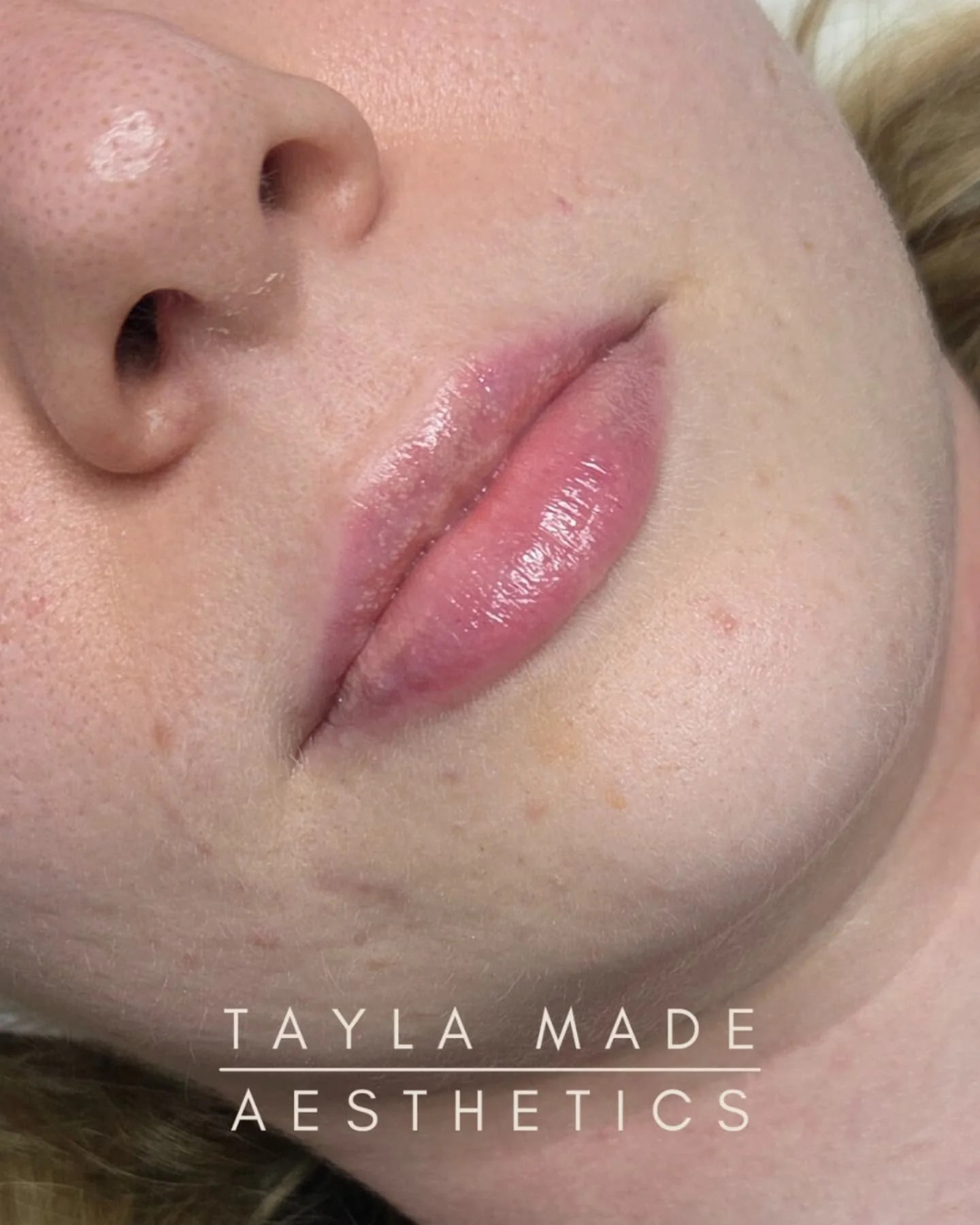 💋Natural Lips

Beautifully Healed ➡️ Before Filler ➡️ Immediately After Treatment

👩🏽&zwj;⚕️I listen to my patients - the assignment:

✅️Your lips to still look like your lips
✅️More plump
✅️Slightly more volume
✅️More definition
✅️Fuller top lip 