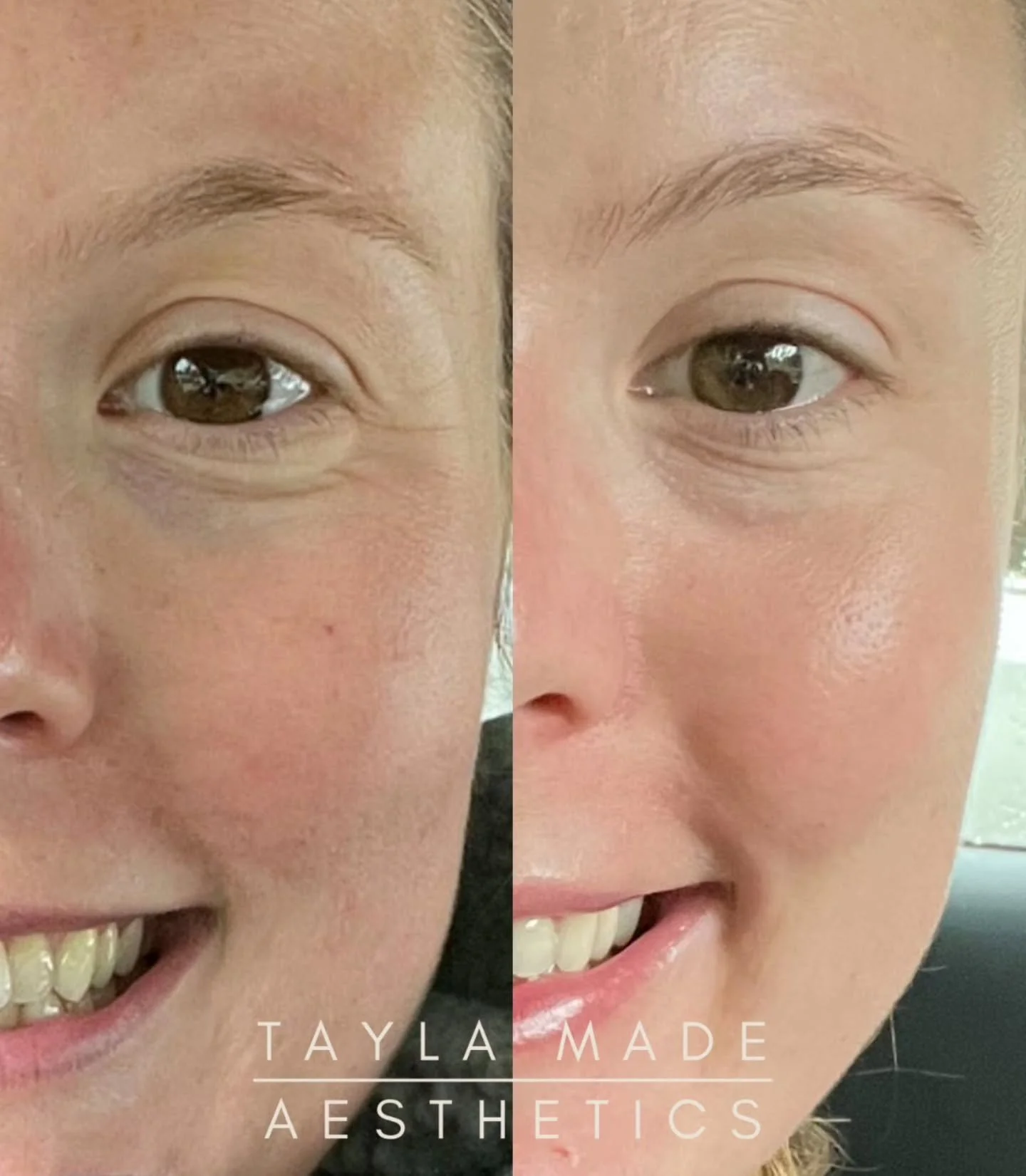 ✨️Glass Skin Facial😍

One of my FAVOURITE treatments🥁...

🪄Microtoxin with NCTF✨️

The Benefits?

➡️ Swipe to see what we achieved
⬇️ Read on to see what YOU could achieve

&gt; Soften fine lines &amp; relax superficial muscle fibers👀💋

&gt; Red