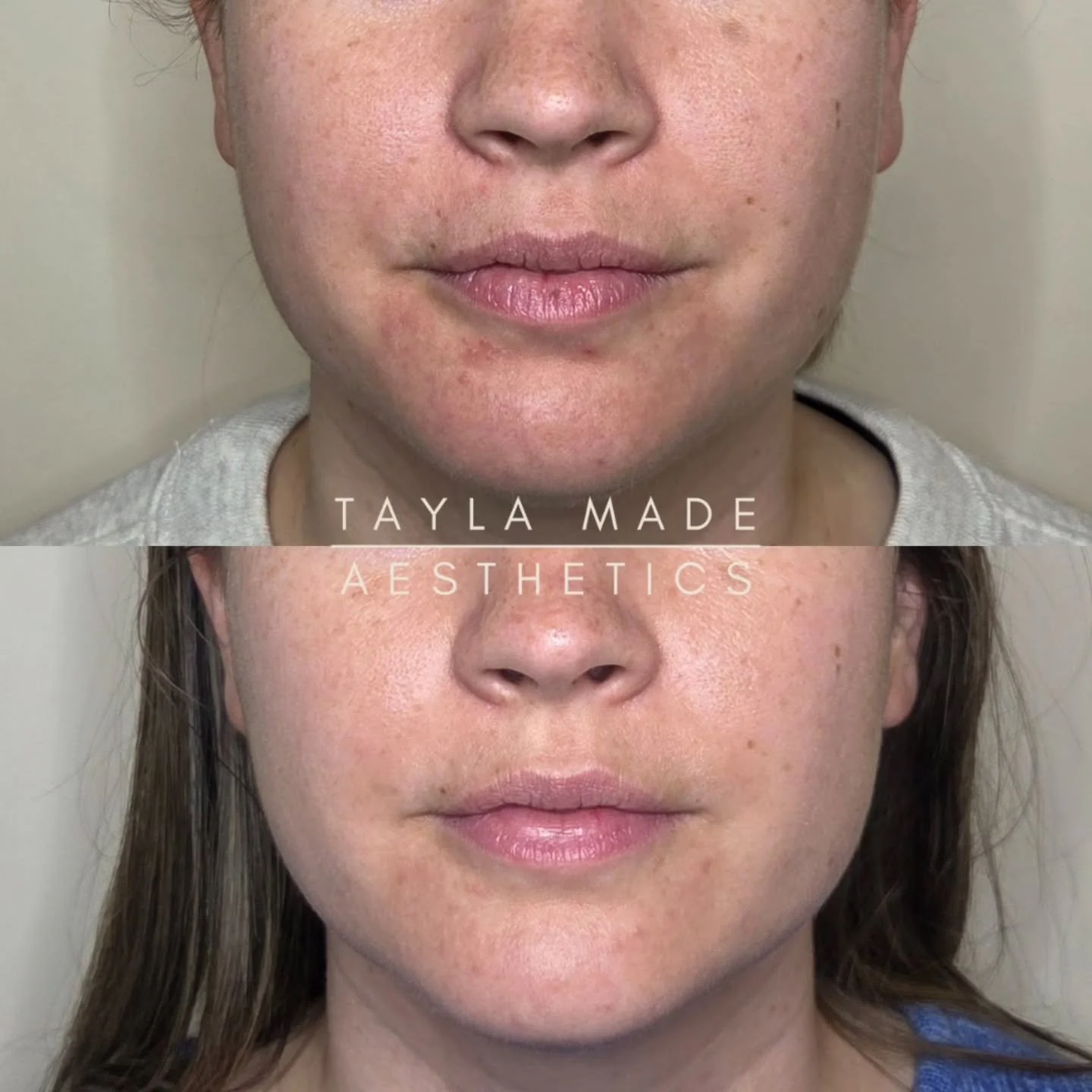 🪄Facial Slimming &amp; Defining Jawlines💫 

The masseter muscle sits low at the back of our jaw, which for it's size, is actually one of our strongest muscles, for which we use to chew our food🍖 

We can gain more strength and size to this muscle 