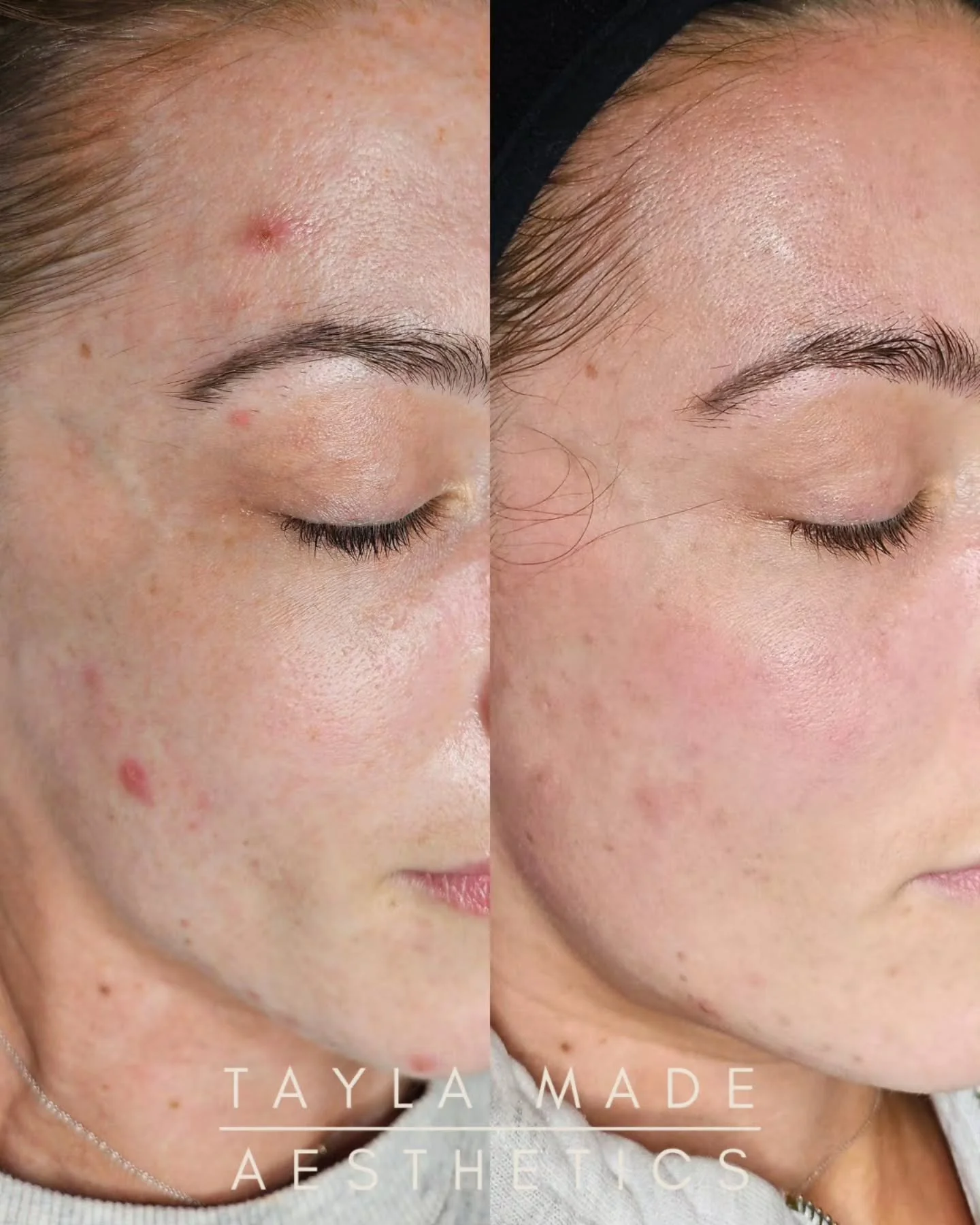 One of my Favourite Treatments🙌🏽💖

✨️The Retinol Peel✨️

Why do I love it? It's suitable for so many skin concerns! A brief overview:

💕 Minimal downtime with light peeling
💕 Reduces oil (great for acne)
💕 Improves sun damage &amp; hyperpigment