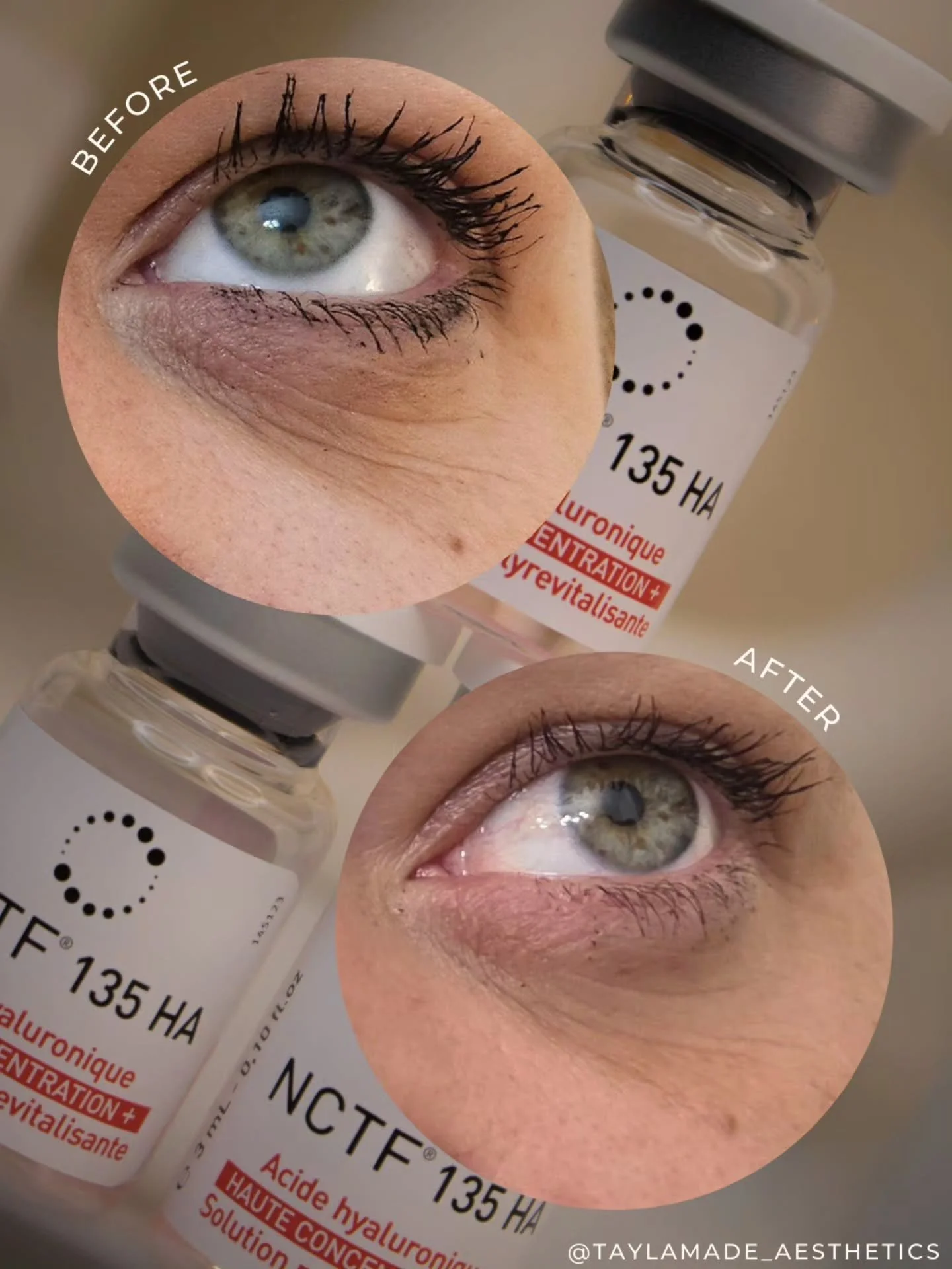 ✨️NCTF vs Polynucleotides🧬 - what&rsquo;s the difference? A question I get asked ALL the time...

👀Both treatments can improve the under eye area, but they work slightly differently👇🏽

✨️NCTF🥗
A powerful skin booster containing hyaluronic acid, 