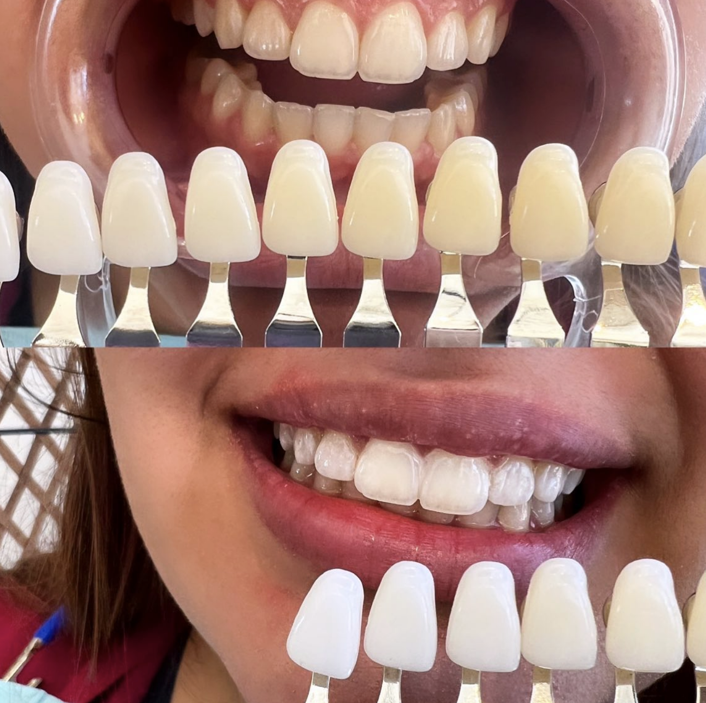 Before and after of teeth a teeth whitening at All That Beauty Bar