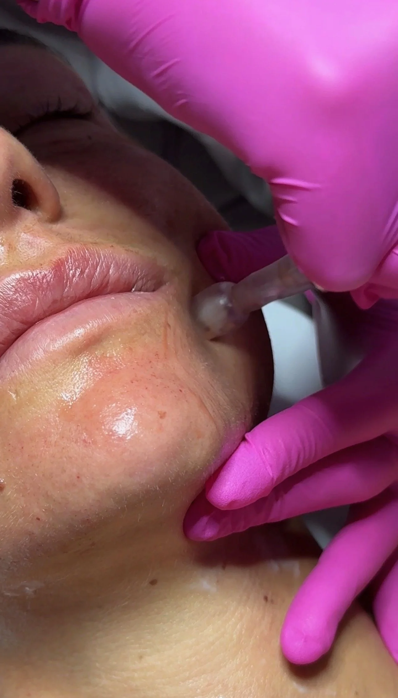 close up of microneedling skin rejuvenation treatment