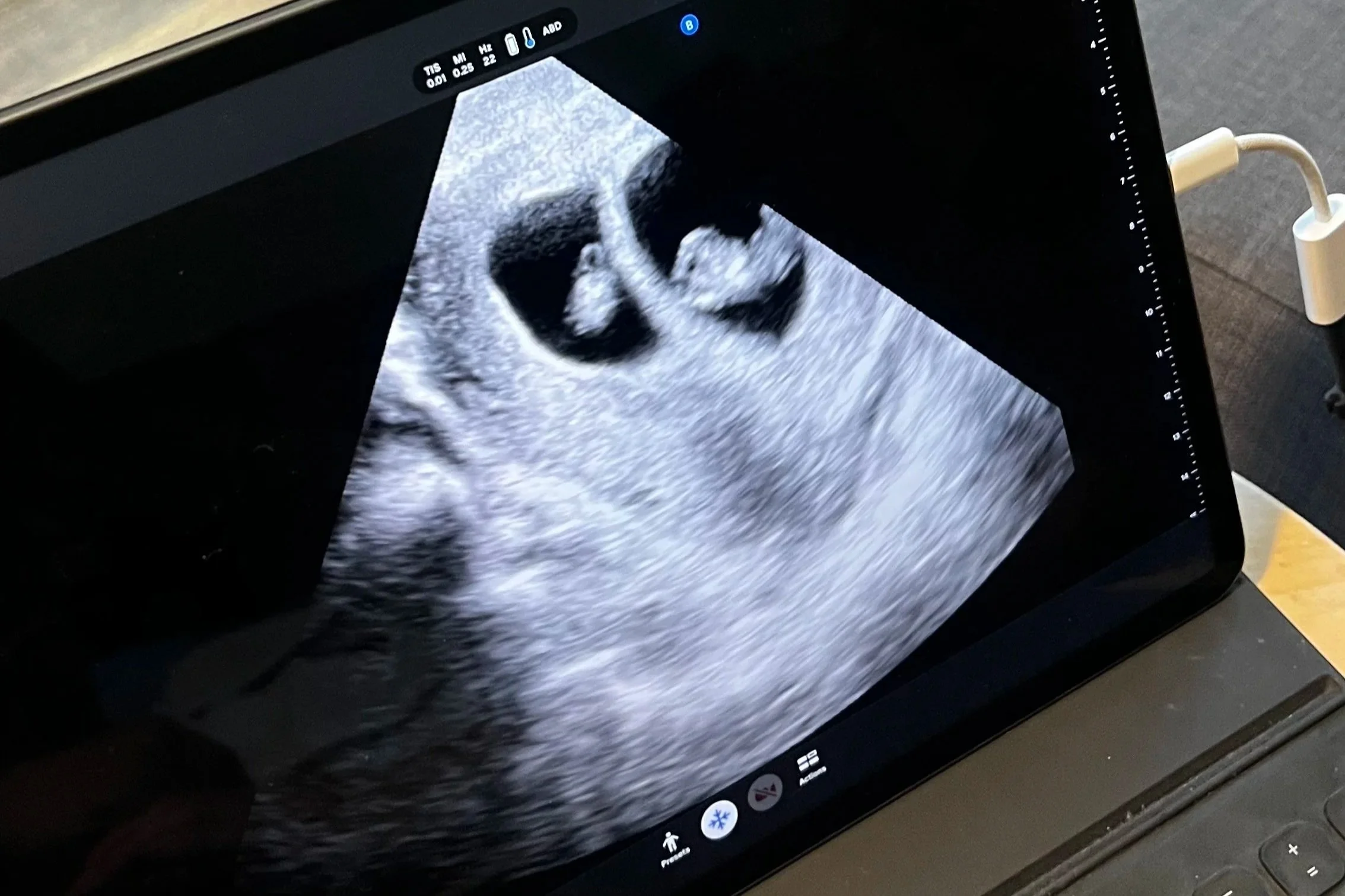 Finding Out We Were Having Twins
