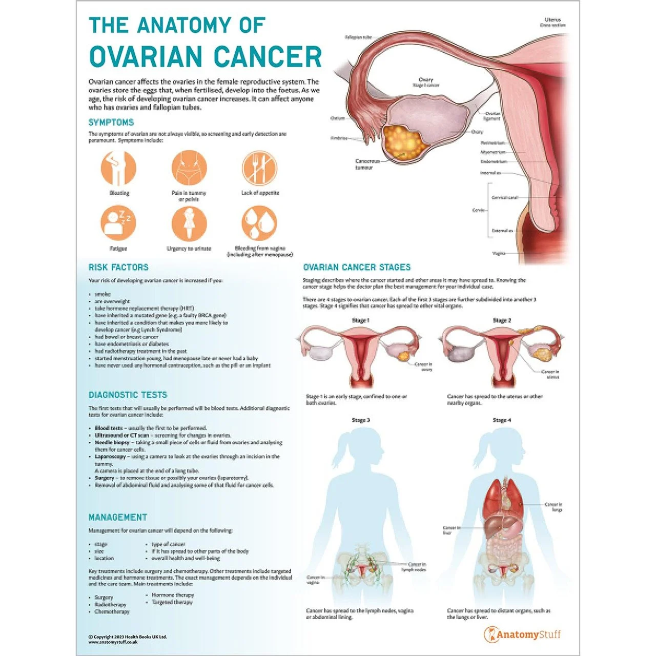 the-anatomy-of-ovarian-cancer-poster-chart__10415.jpeg
