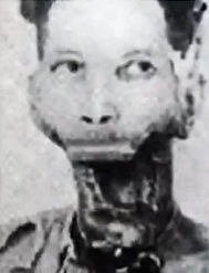 Eben Byers: The Man Whose Jaw Fell Off