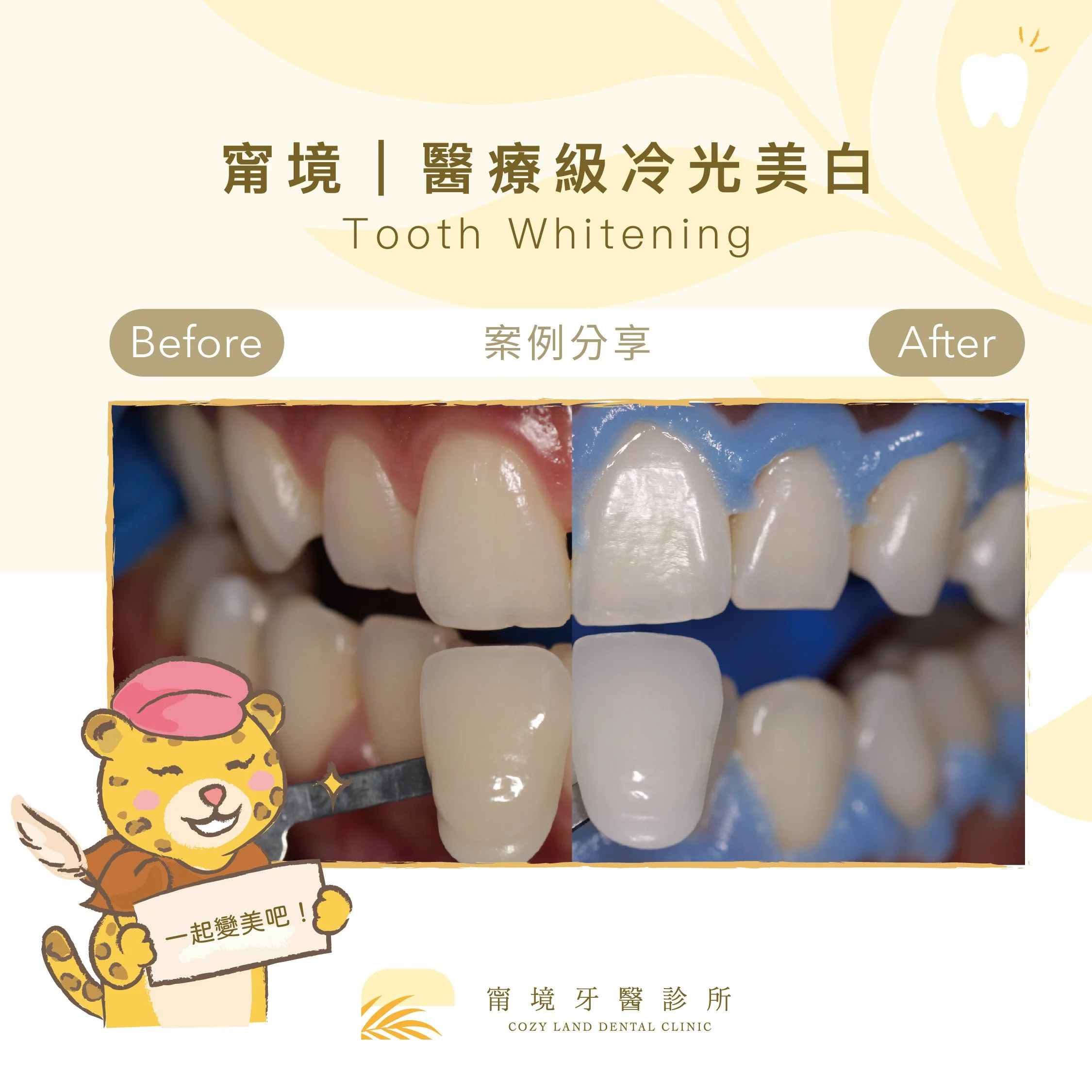 甯境醫療級冷光美白