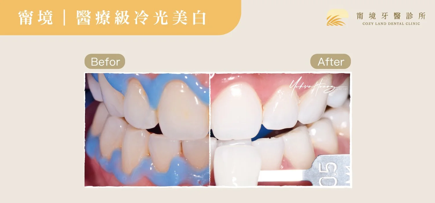 甯境牙醫冷光美白介紹圖 2｜冷光 vs 噴砂 vs 美白貼片各方式比較說明