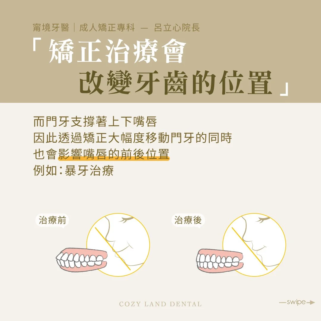 矯正會改變牙齒位置說明圖 2｜門牙移動連帶改變嘴唇前後位置，改善暴牙外觀