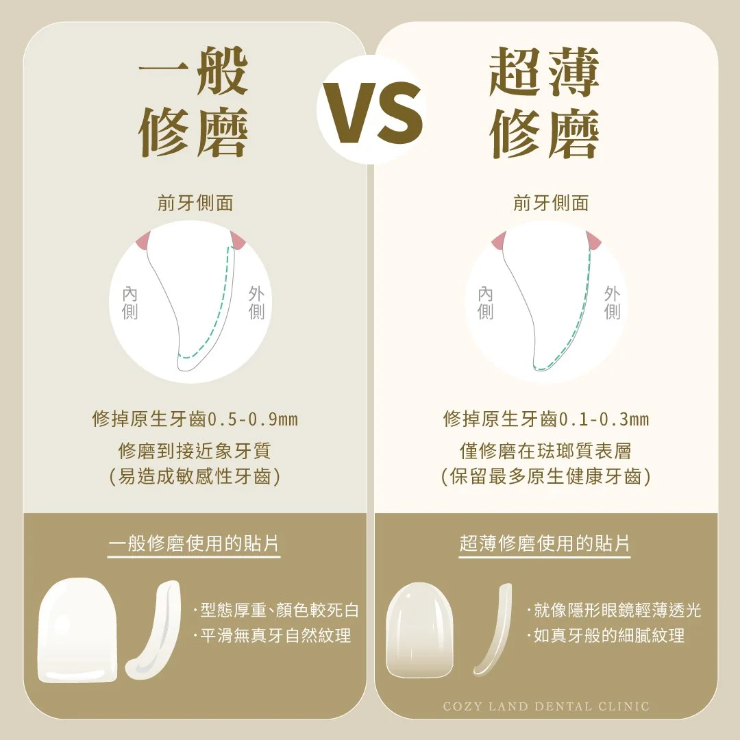 甯境牙醫超薄修磨技術說明圖 1｜修磨量 0.1–0.3mm 保留最多琺瑯質，黃裕新醫師