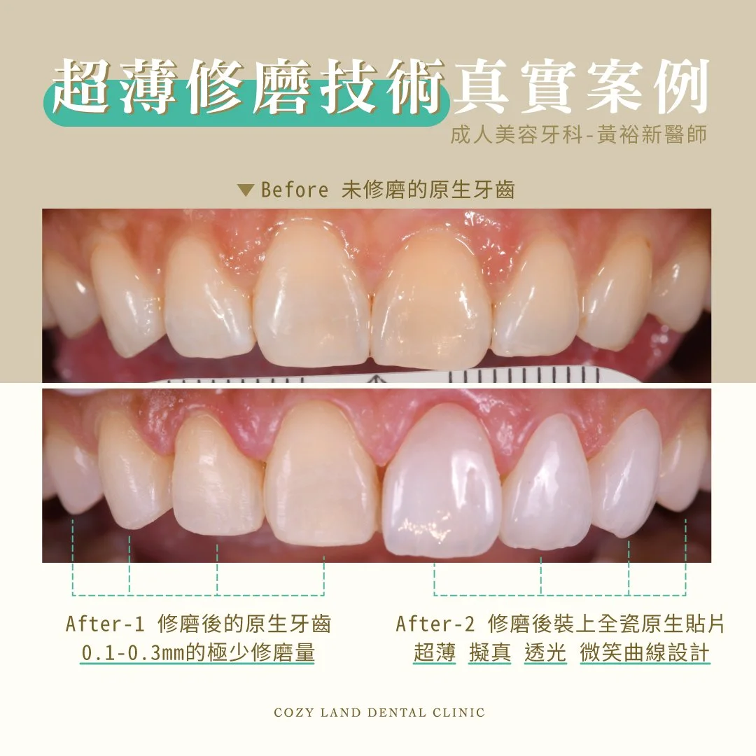 黃裕新醫師超薄貼片真實案例照｜斷裂染色齒質修復，如原生齒般自然光澤紋路