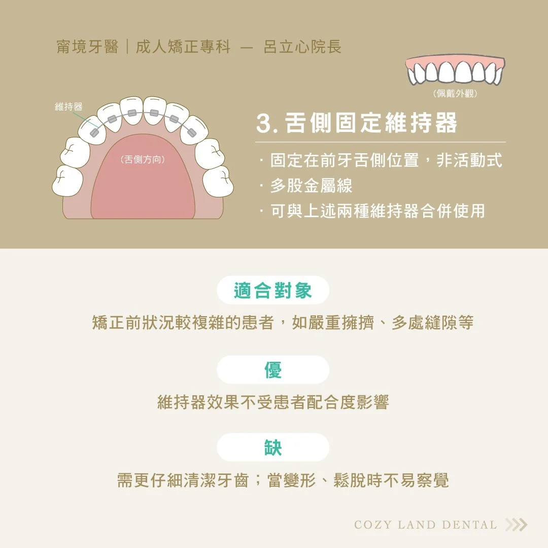 舌側固定維持器（Lingual Fixed Retainer）介紹說明圖｜固定在前牙舌側的非活動式維持器
