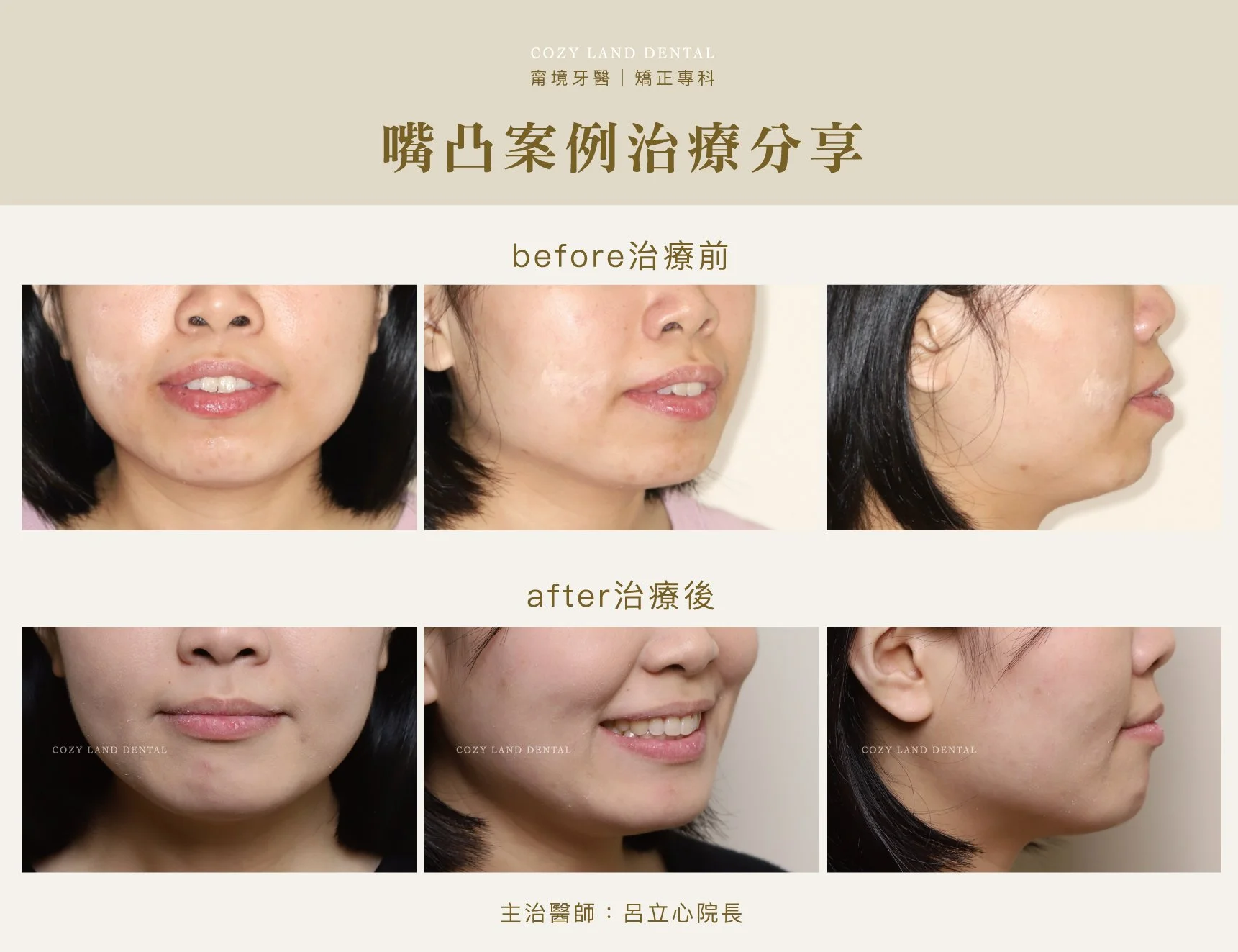 覺得嘴凸影響外觀臉型嗎？從臉型比例到矯正評估帶你看懂
