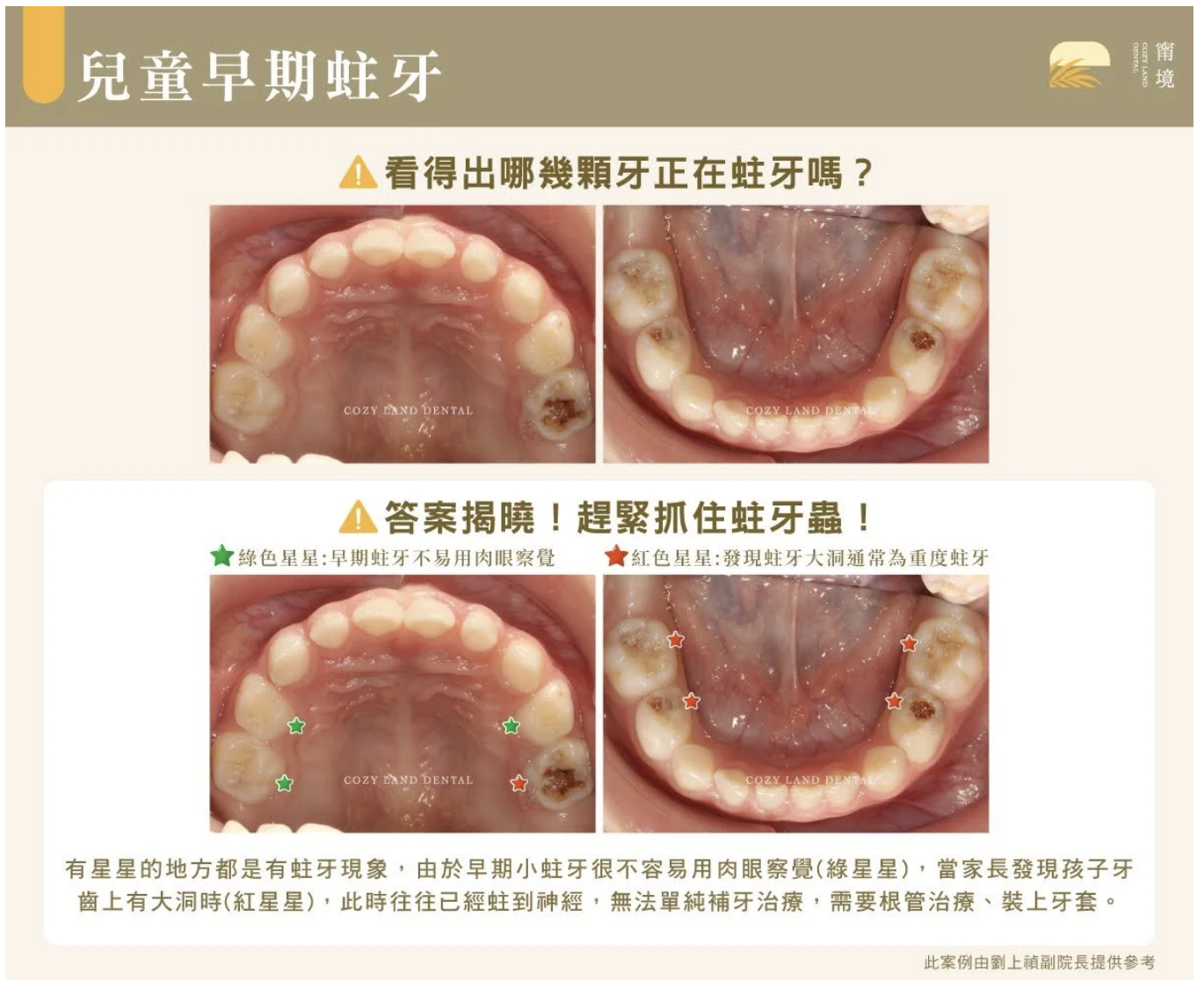 小孩蛀牙3 大前兆長怎樣？初期、凹洞到重度照片對照