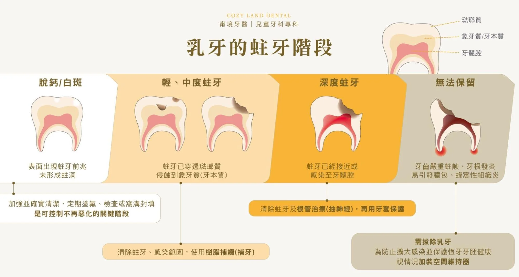 乳牙蛀牙4階段