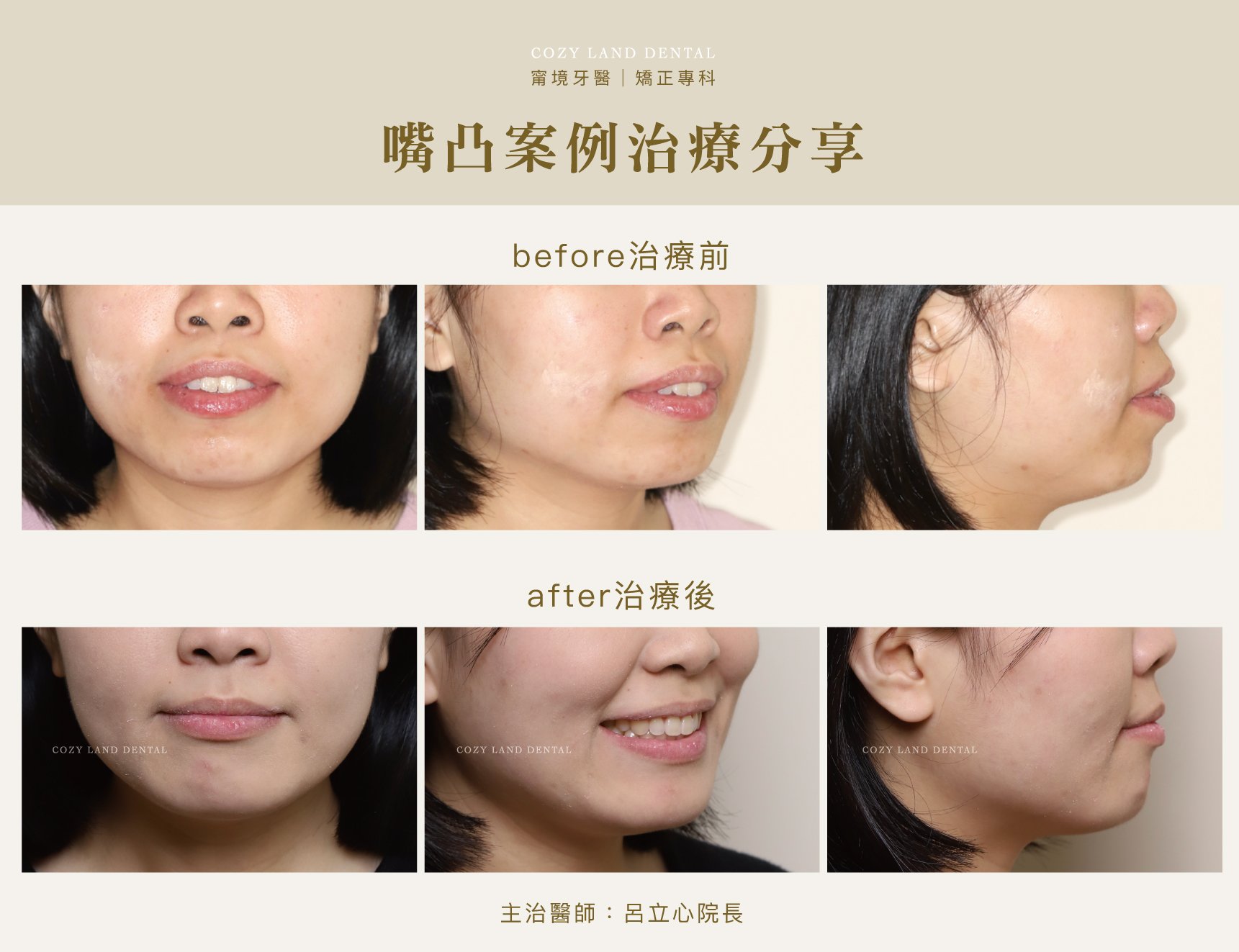 嘴凸治療前後差別對比