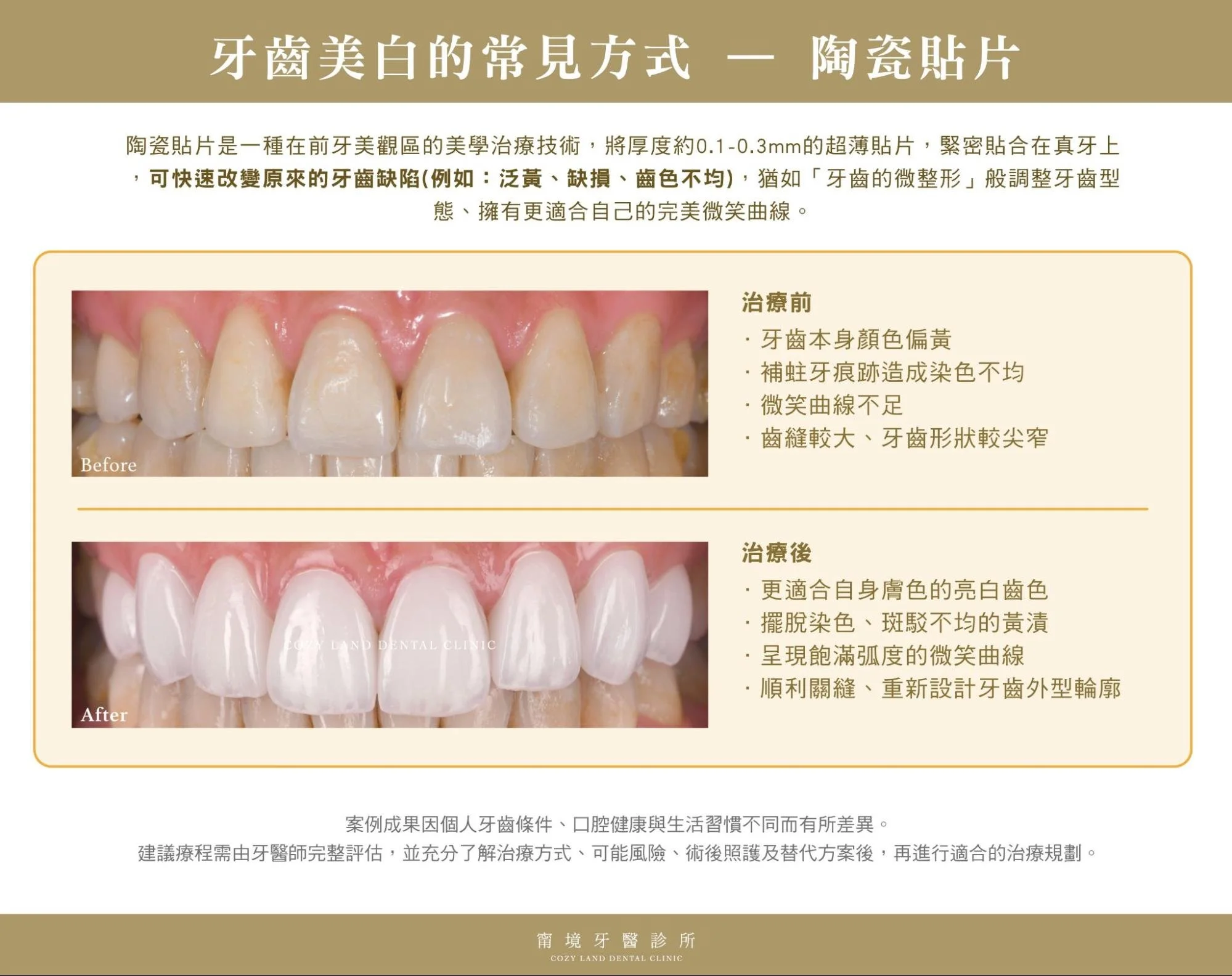 牙齒美白：陶瓷貼片