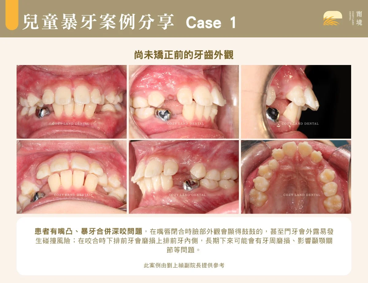兒童暴牙示意圖｜暴牙外觀與基本定義，嘴唇閉合困難的外觀特徵