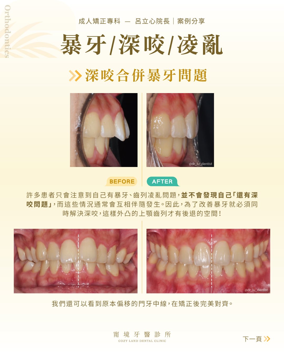 咬合不正原因分析圖｜遺傳因素 vs 後天習慣（口呼吸、吸手指）