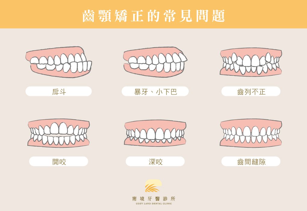 兒童常見齒顎問題需早期矯正說明圖｜錯咬、暴牙、齒列擁擠等需提早介入說明