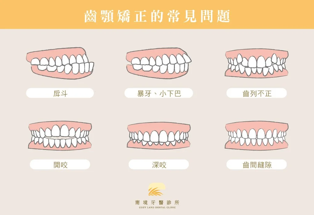 常見咬合不正齒顎問題說明圖｜深咬、暴牙、地包天、開咬類型比較