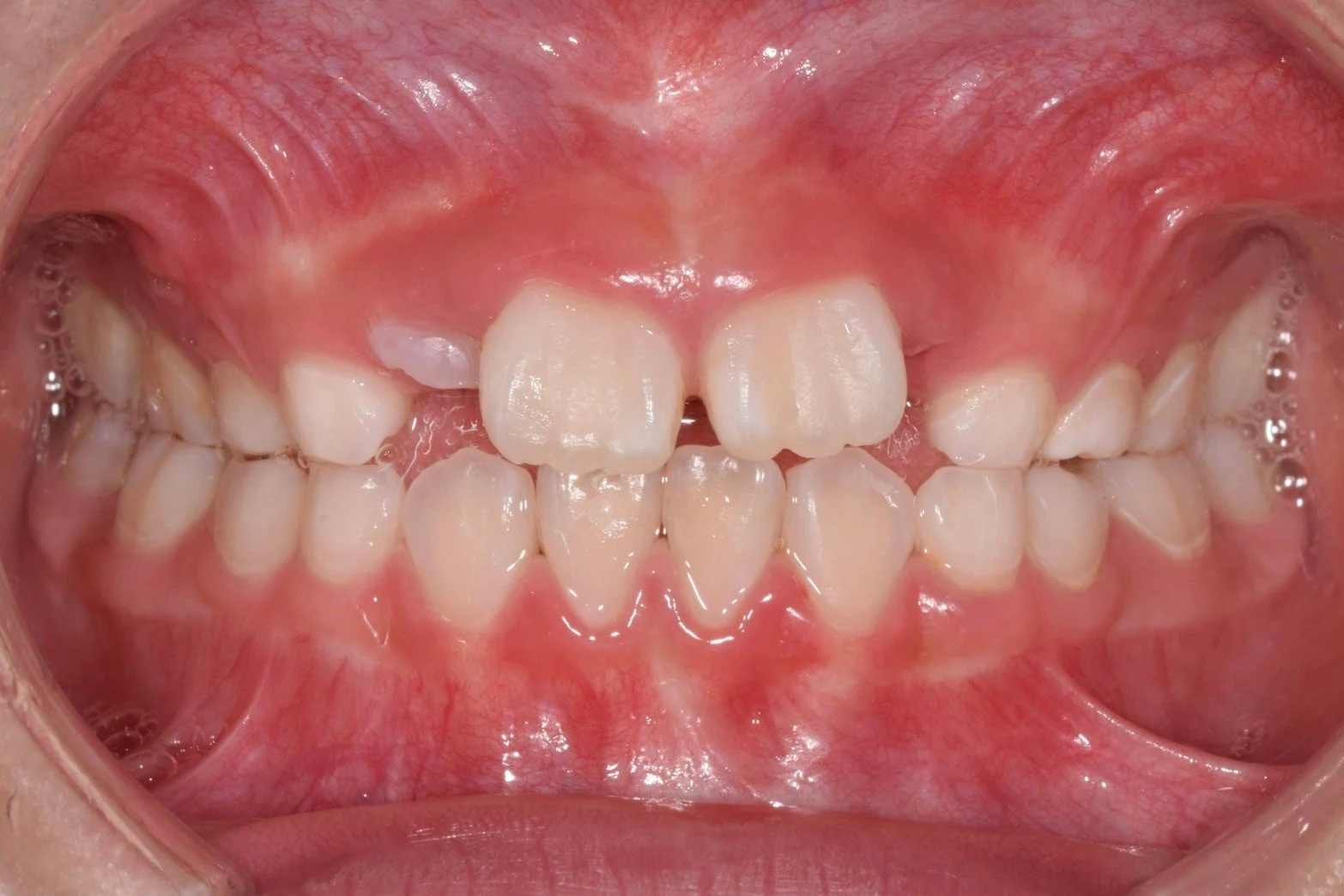 換牙醜小鴨期（Ugly Duckling Stage）示意圖｜上排門牙外八為正常換牙現象