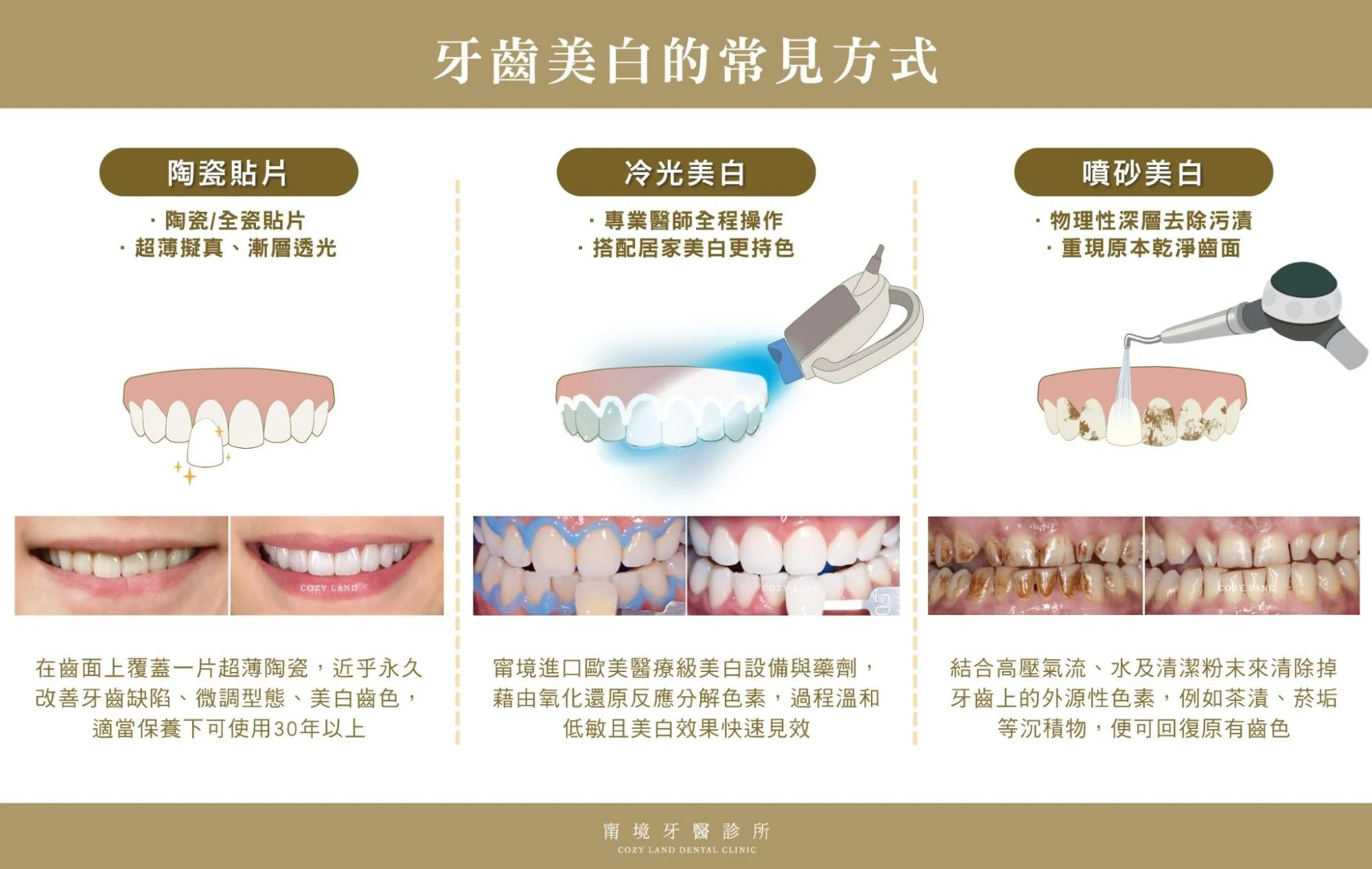 牙齒美白方式：陶瓷貼片、冷光美白、噴砂美白