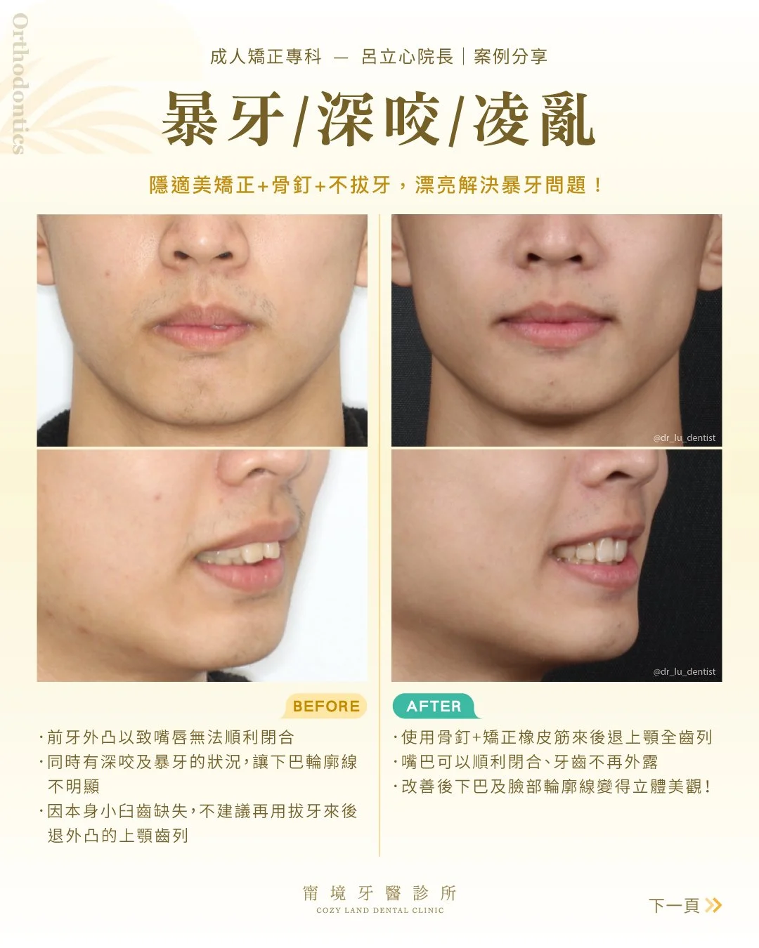 咬合不正分級說明圖｜Angle 第一、二、三級咬合不正差異比較