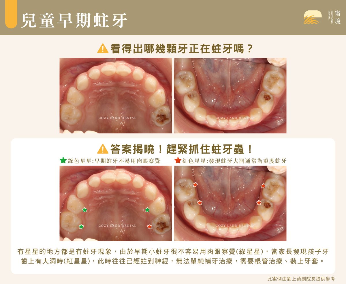 兒童早期蛀牙徵兆