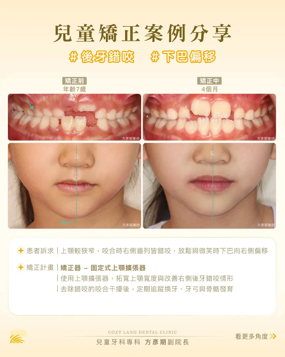 甯境牙醫兒童矯正案例縮圖｜7 歲後牙錯咬下巴偏移矯正前後對比（方彥期副院長）
