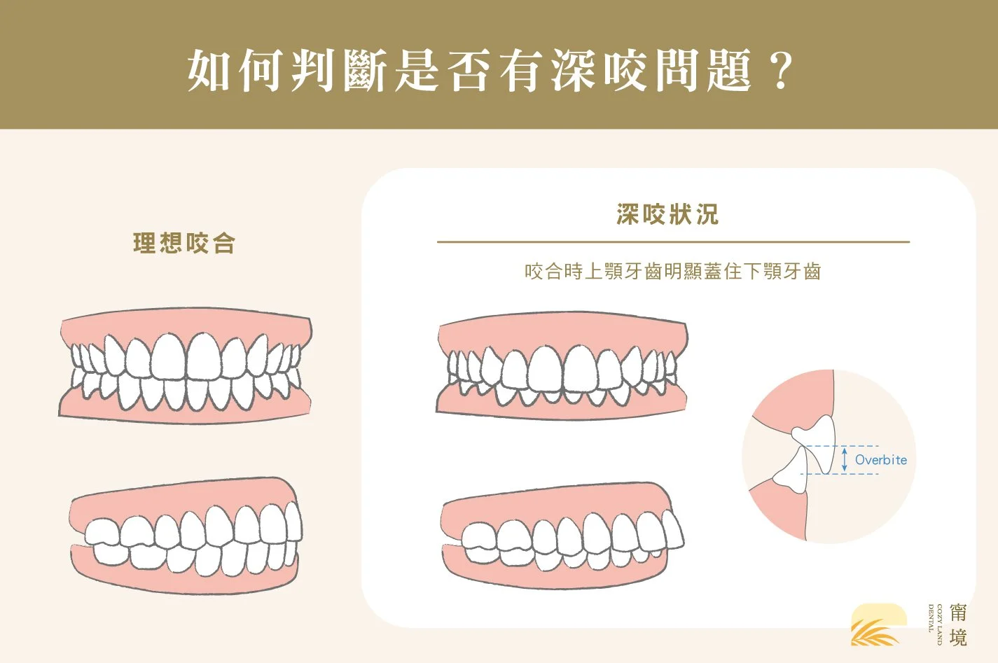 深咬咬合不正定義說明圖｜正常咬合 vs 深咬（下排門牙被覆蓋超過 4mm）比較