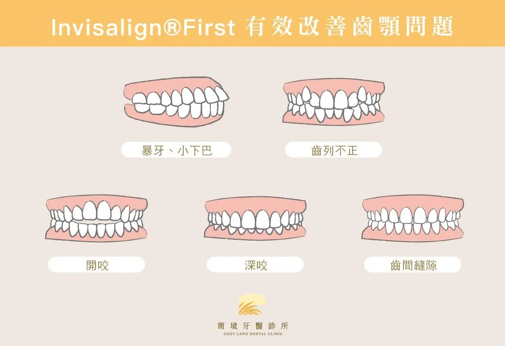 甯境牙醫兒童隱適美矯正說明圖｜Invisalign First 透明牙套外觀展示，混合齒列期適用