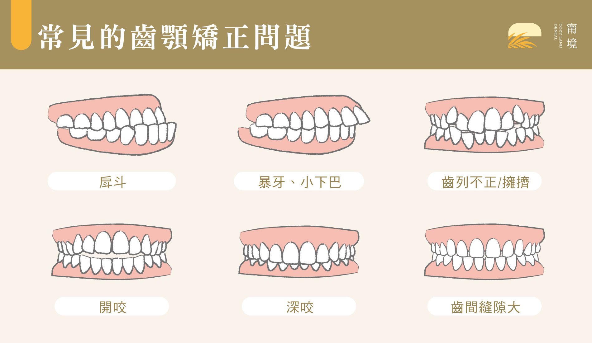 牙齒不整齊類型示意圖｜齒列擁擠、暴牙、地包天等常見排列問題