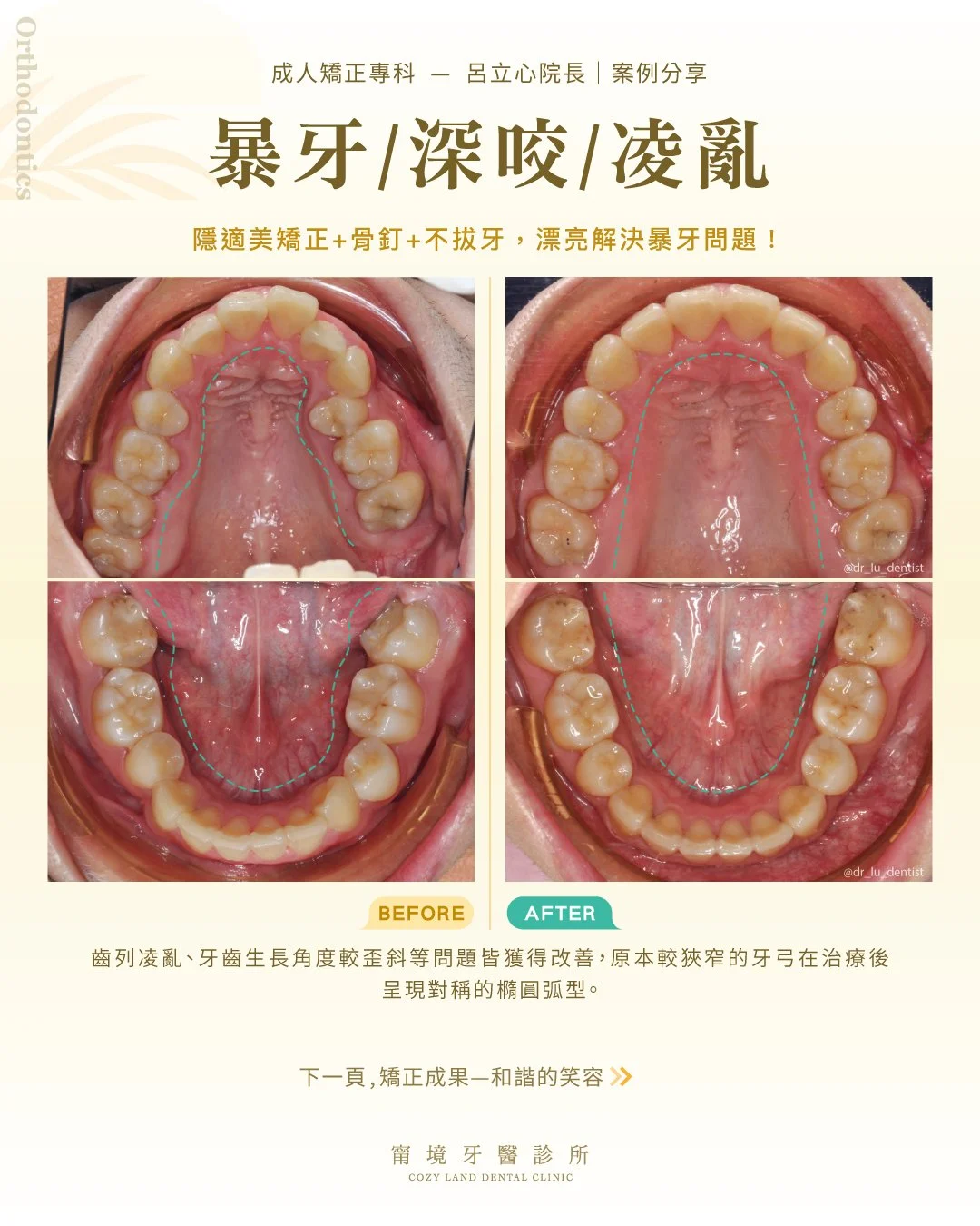 醫師評估咬合不正流程圖｜X 光、3D 掃描與咬合分析說明
