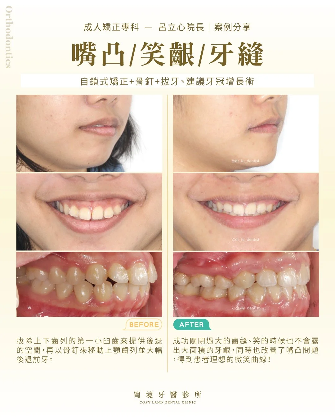 甯境牙醫成人矯正中照片｜拔牙搭配骨釘前牙後退治療過程，改善嘴凸笑齦（呂立心院長）