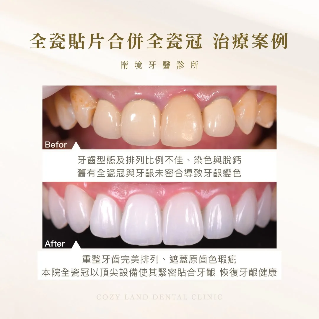 甯境牙醫全瓷貼片合併全瓷冠治療前後對比圖｜多顆牙整合美學修復，兼顧美觀自然健康