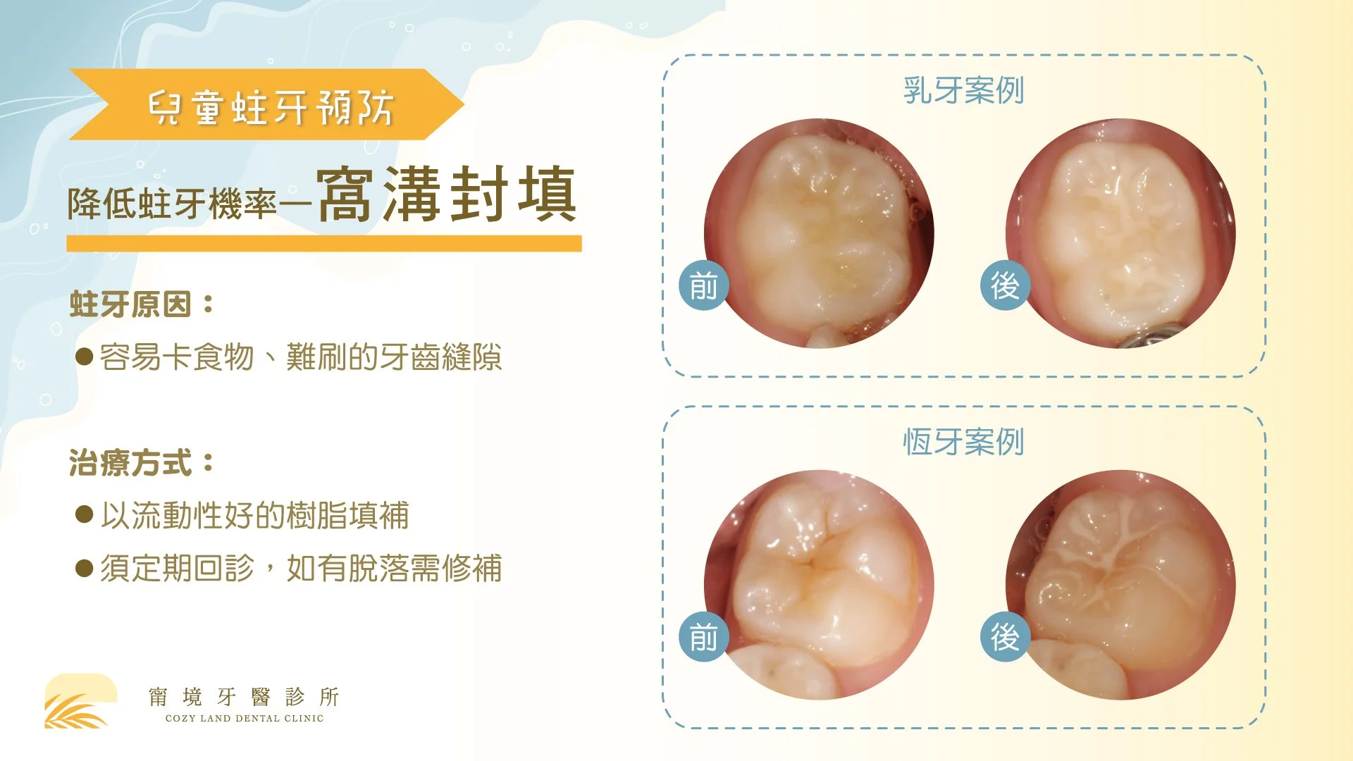 溝隙封填 4 步驟流程圖｜清潔、酸蝕、塗布、硬化步驟說明