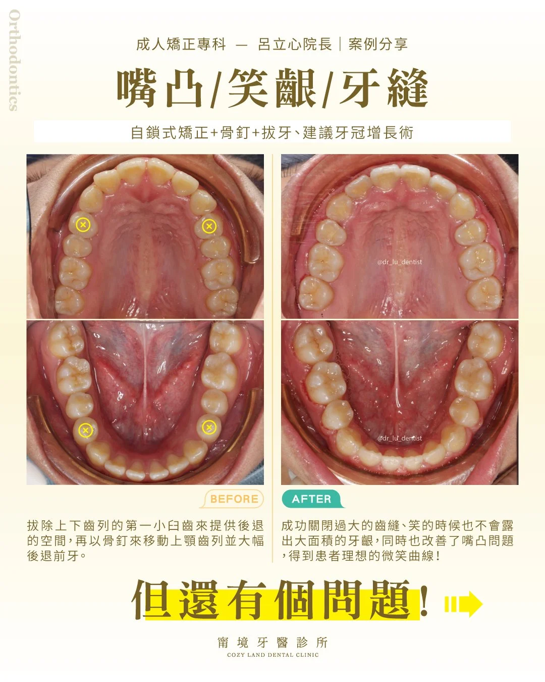 甯境牙醫成人矯正後側臉輪廓照｜嘴唇收退後側顏比例改善（呂立心院長）